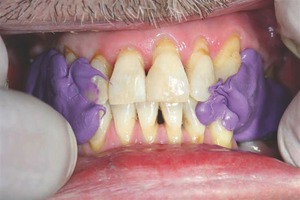 FIGURE 7--Finger pressure against cheek, creating flat buccal wall.