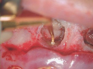 FIGURE 18--Jetip Surgical. (Courtesy Dr. Marga Ree, Netherlands)