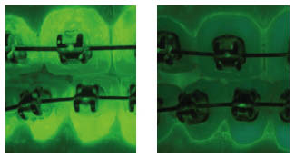 Figure 4 - Plaque Before & After 2-Weeks Use in Orthodontics.