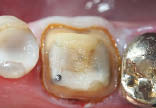 Figure 10B. Second cord in place. Note the degree of gingival retraction and complete visualization of all the margins of the crown preparation.
