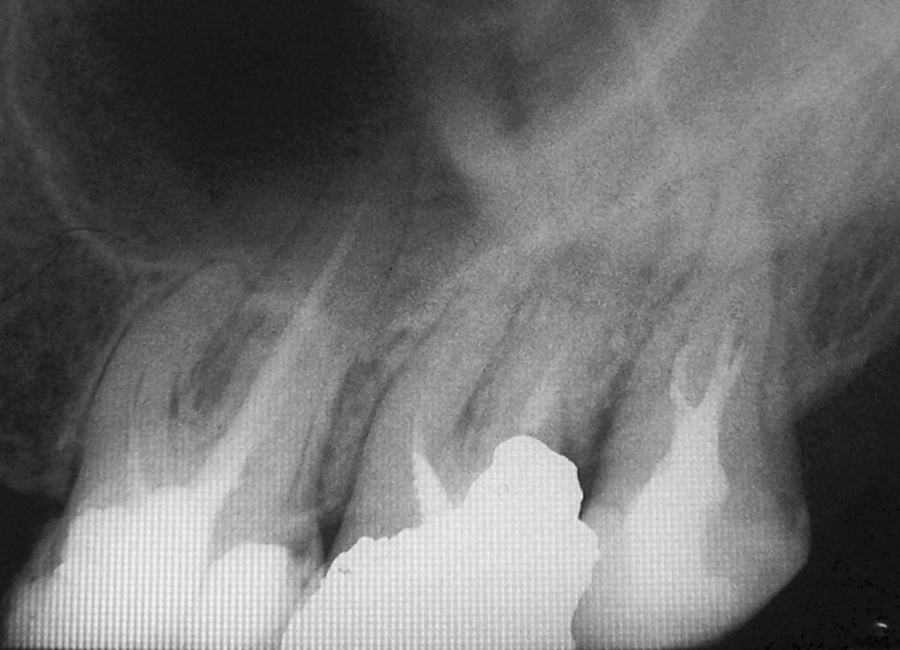 Figure 1. Preoperative radiograph of tooth 2.7 (#14).