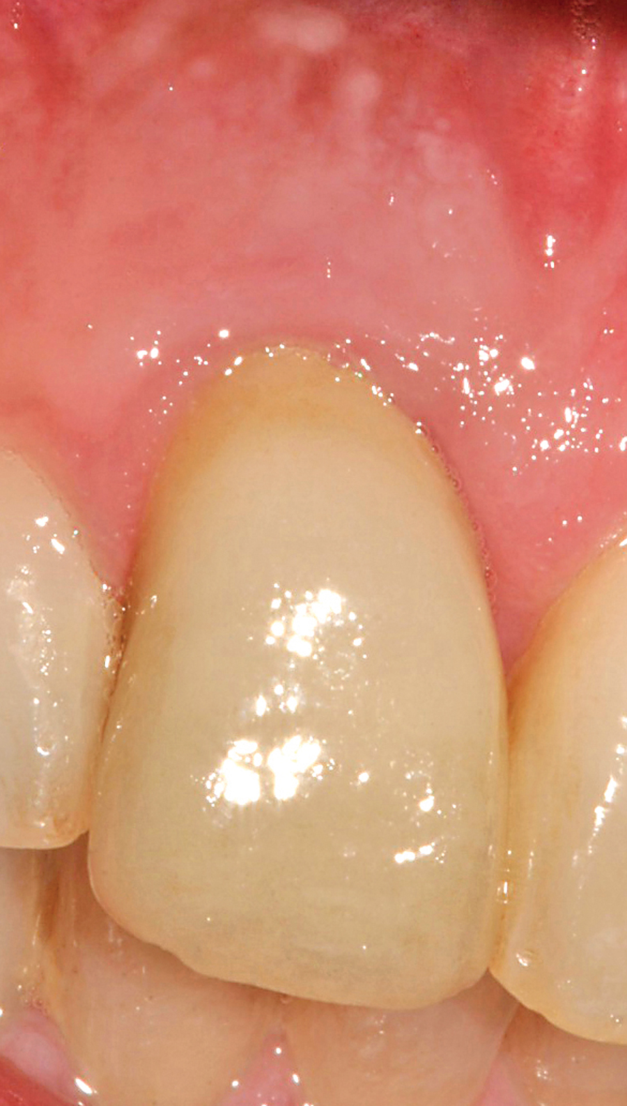 Figure 15. Final Result 3 years postoperatively.