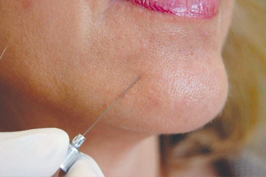 Figure 5. Pin-Prick Test: A 27-guage needle is used to test for pressure detection and anesthesia/paresthesia/dysthesia.