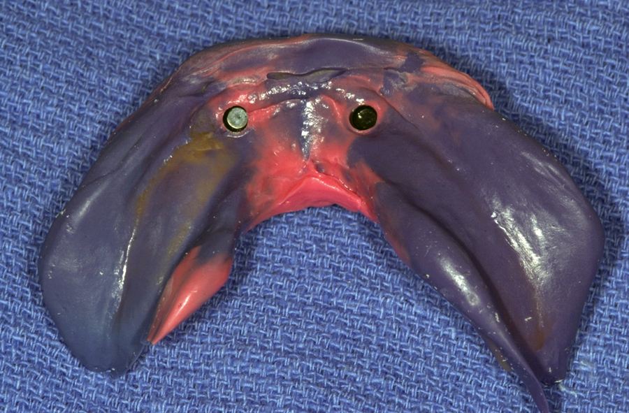 Figure 10. In this photo, the female components have been picked up from the new intra-oral male components in a full PVS impression. This impression will be used not only for ideal positioning and stabilization of the new female components, but for a full denture reline as well (the first one he has had since he left the practice 22 years ago).