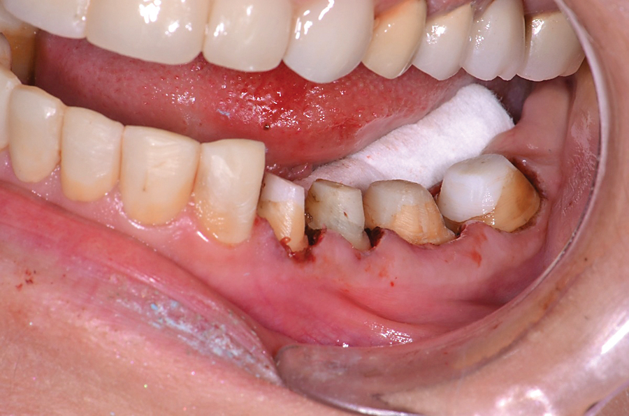 Figure 15. The multiple preparations are ready for impression