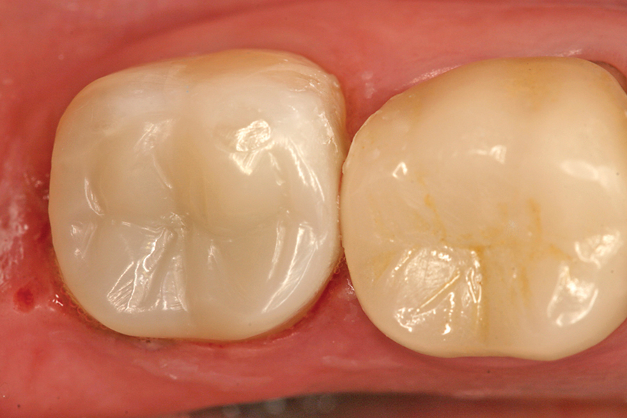 Figure 7. Immediate post-operative view of the nano-ceramic resin onlay for tooth #18.