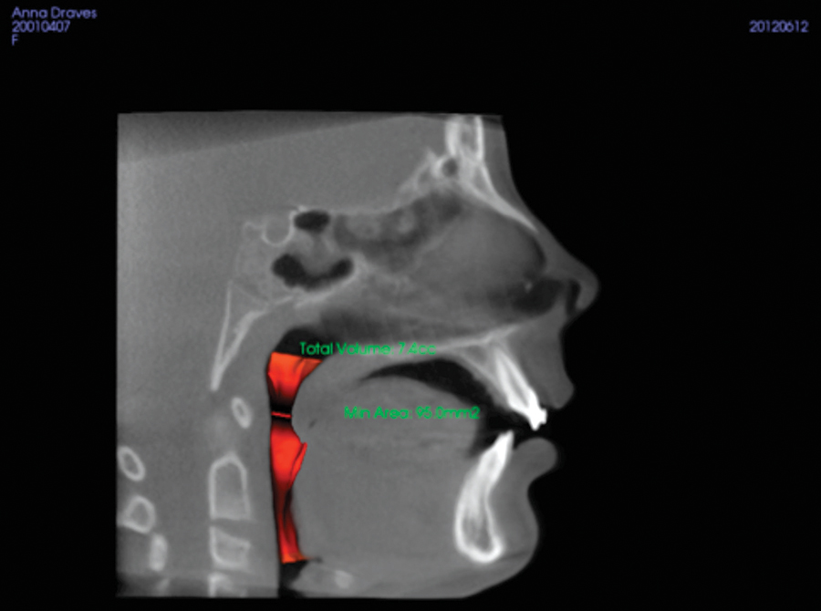 Figure 6. 4 months Orthopedic expansion