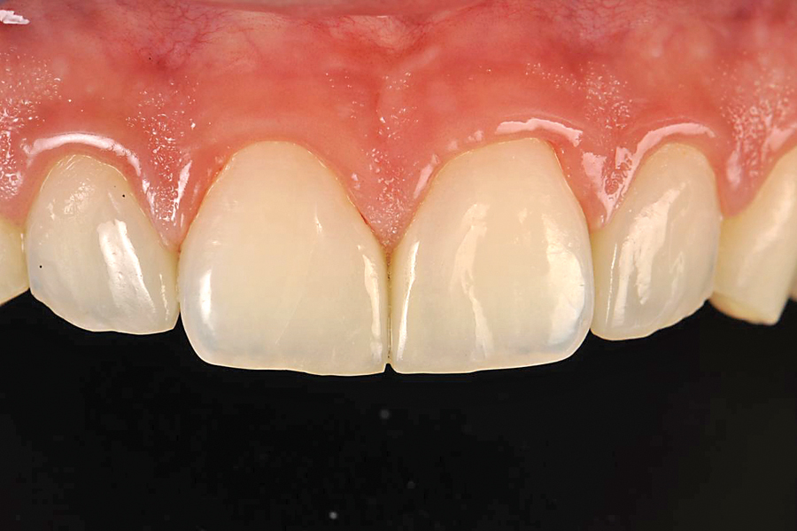 Figure 11. The additional veneers after 13 months. Esthetics are maintained. The papillas have a nice natural look, even without teeth reduction. Even if on a macro view the margins can be seen, the esthetic limitations of such a case have almost no impact if compared to the non-aggressiveness of the procedure.