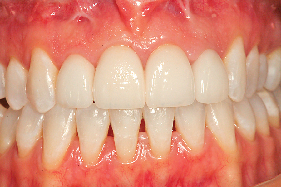 Figure 22. A retracted full arch view of the completed combination tooth whitening/porcelain veneer case at a one-month follow up visit.