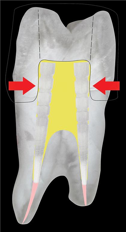 Figure 8. When preparing a ferrule on a tooth with a wide flare, the preparation removes all lateral dentin creating a stand-alone core which drastically decreases the clinical success rate.
