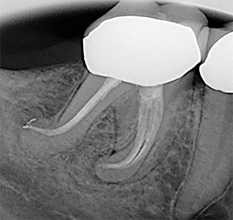 Figure 10. Post operative radiograph with distal angulation (obturation of 3 mesial canals).