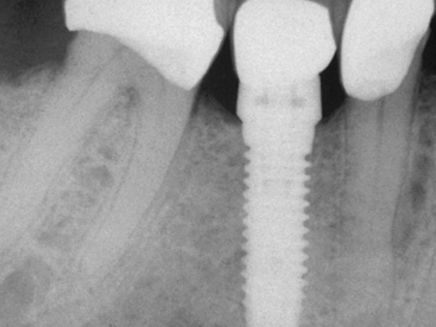 Figure 13. A nine year post operative x-ray with no clinical complication.