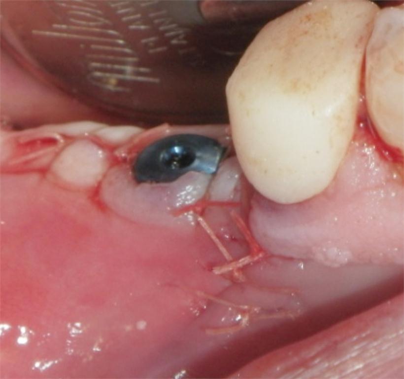 Figure 4H. Post-operative image after flap closure and suturing.