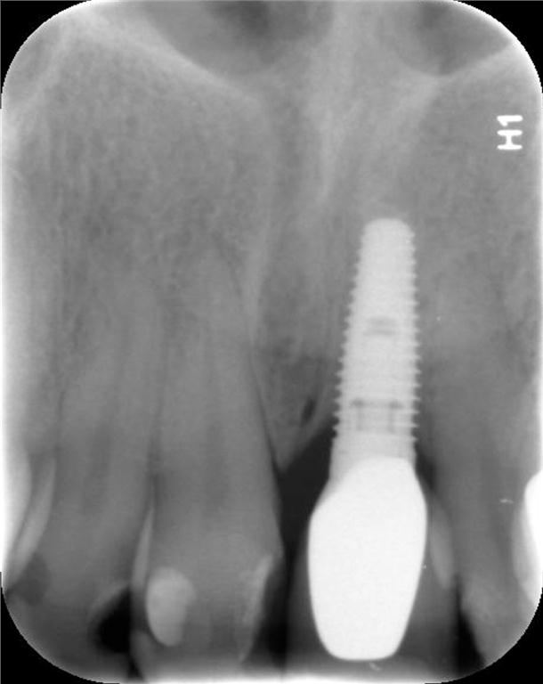 Figure 3. Implant at tooth position #9 is fully osseointegrated and stable in oral bone 30 months post-placement.