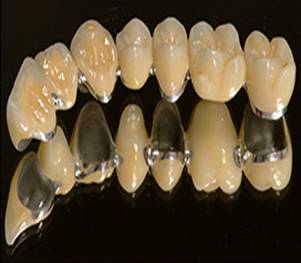 Tried and tested in conventional dental technology  a veneered Wirobond 280 bridge