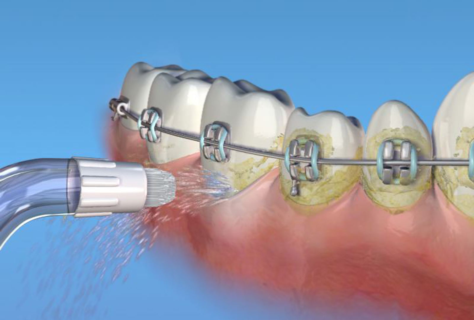Waterpik Orthodontic Tip alternate text for this image