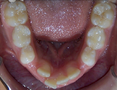 Mandibular Crowding
