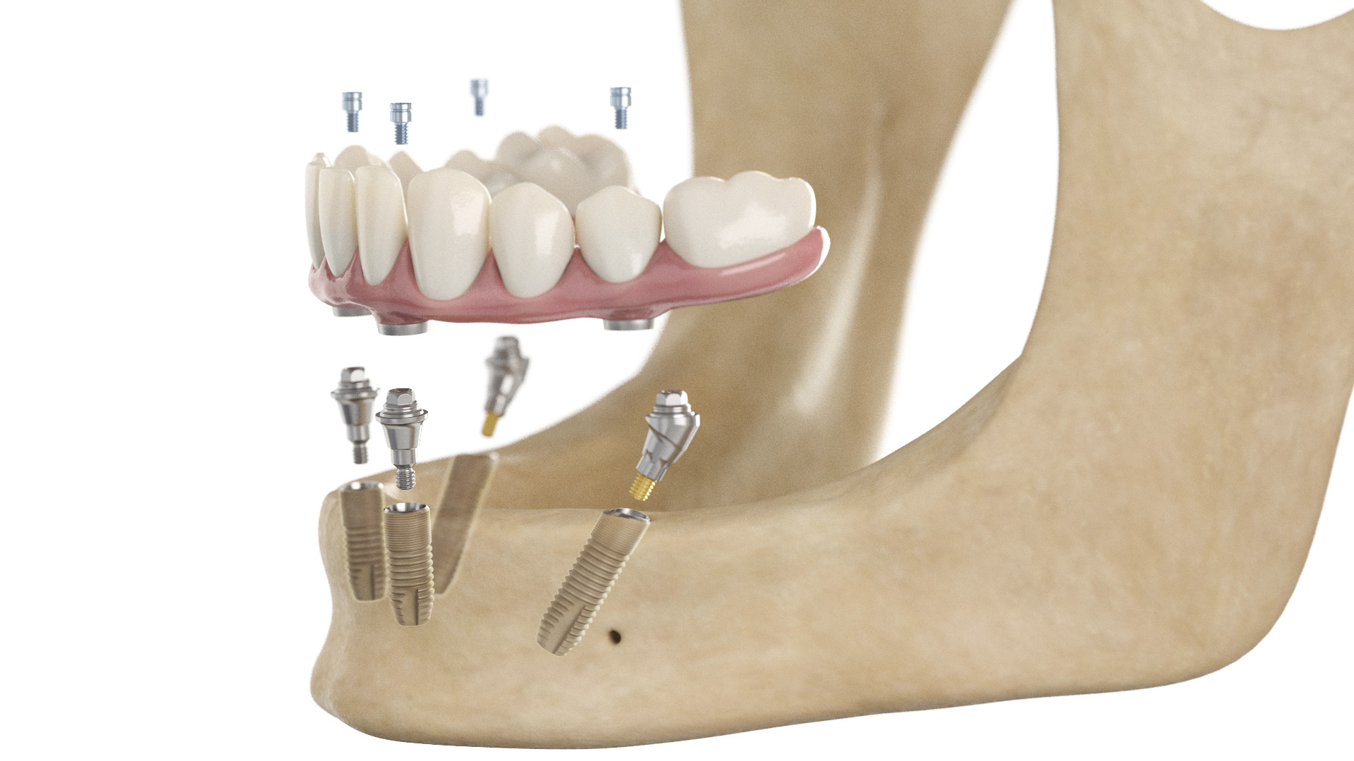 DS_Implants_SmartFix alternate text for this image