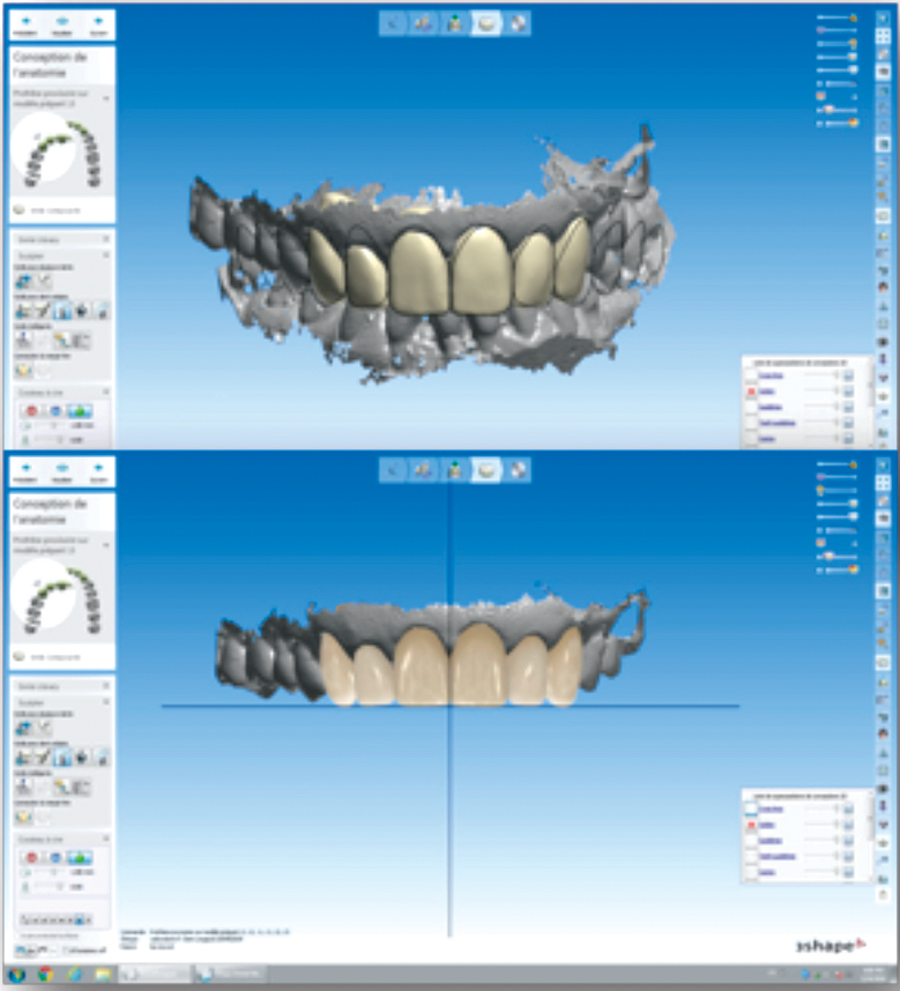 3D Digital Smile Treatment Plan