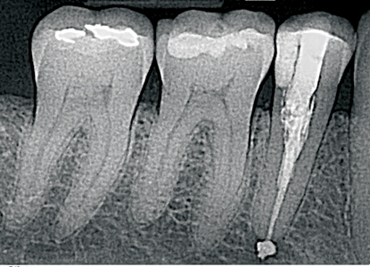 Internal Cervical Resorption