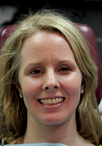 Full Mouth Reconstruction