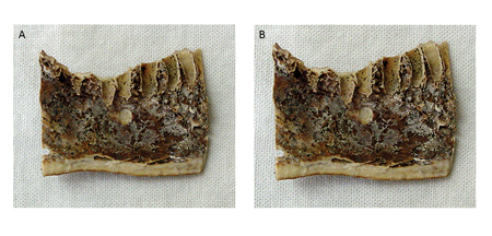 Buccal-Radial Radiographic Projections Allow Accurate Detection Of Cortical Bone Defects In Cadaver Mandibles By Practitioners With Different Levels Of Expertise