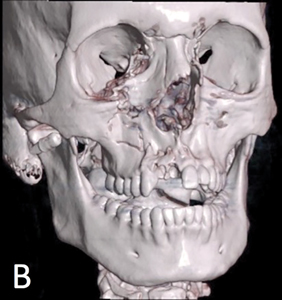 Orbital and Ocular Trauma