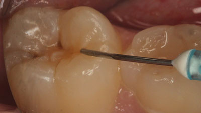 Fissure Sealants