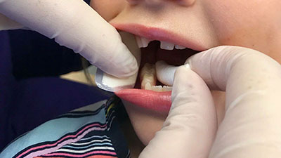 Silver Diamine Fluoride