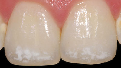 Paediatric Restorative Materials