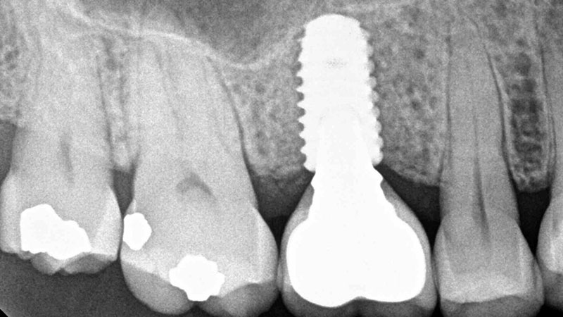 Implant Failure