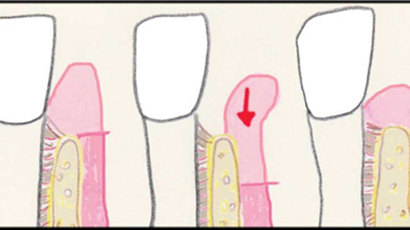 Aesthetic Crown Lengthening