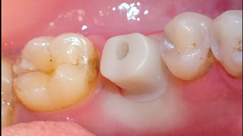 A zirconia hybrid abutment in place