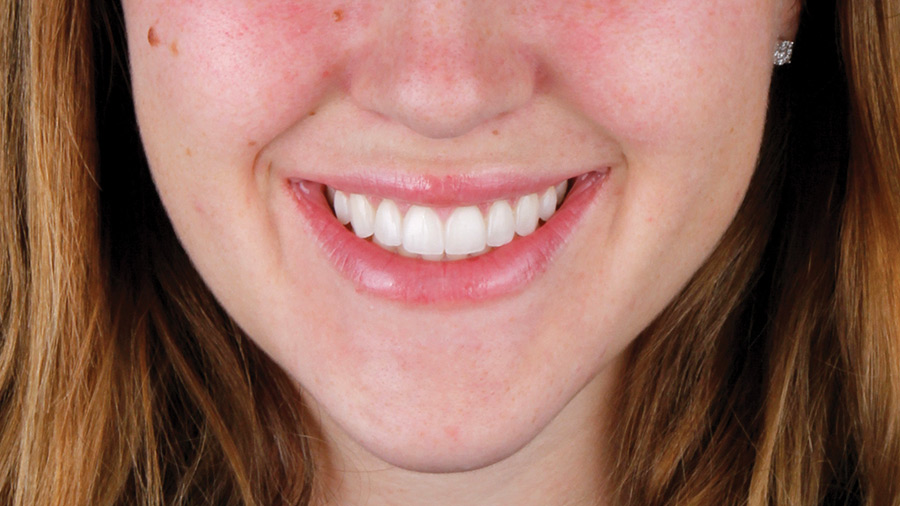 Porcelain Veneers