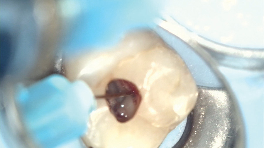 Close up view of needle engaged in canal for intrapulpal injection.