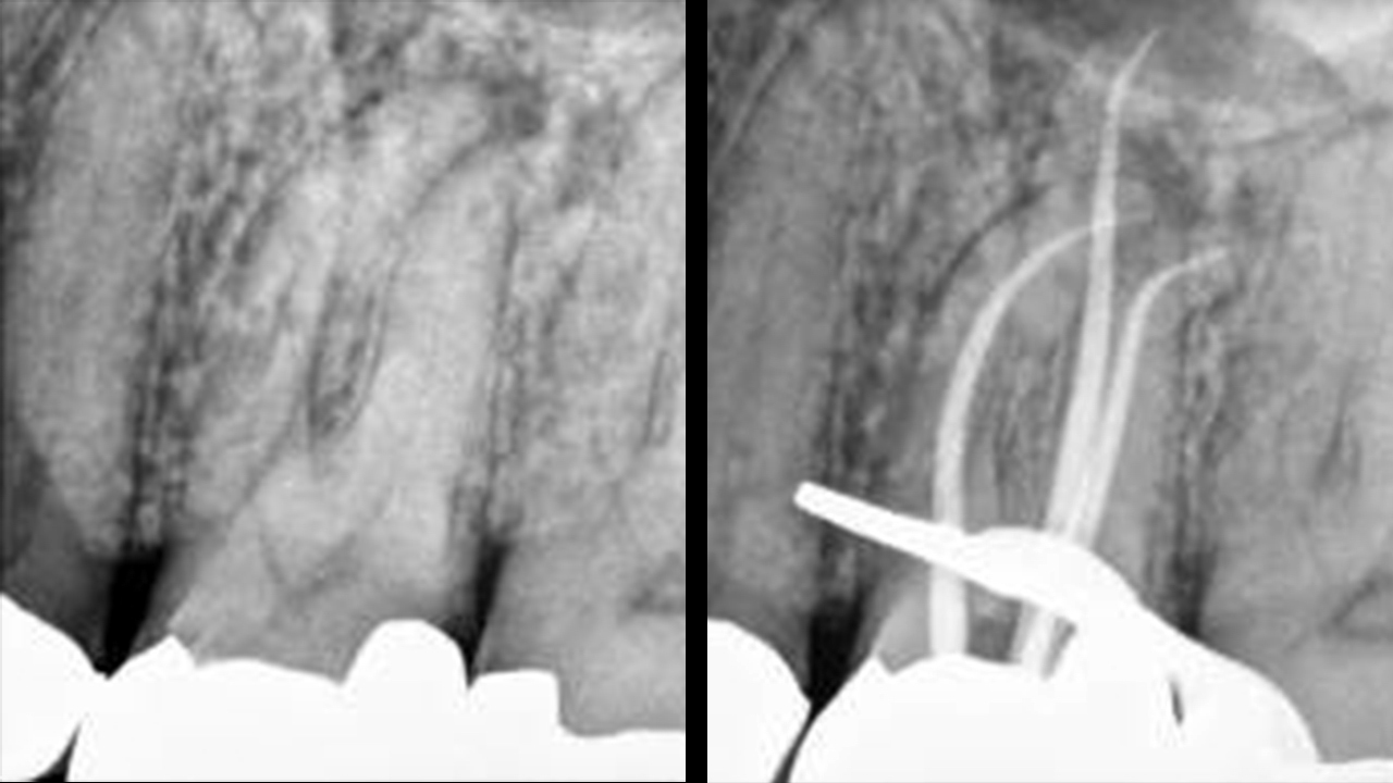 A clinical example of 3 successful conefits to be easily followed by predictable 3-D obturation.