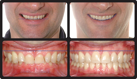 Non consonant (flat) and Consonant Smile Arc.