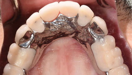 Hypohidrotic Ectodermal Dysplasia
