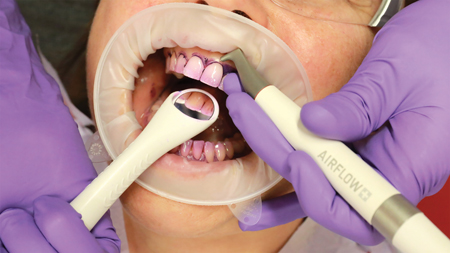 Aerosols in Dentistry The bacterial contamination of the room air during an AIRFLOW® treatment