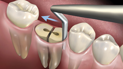 Implant Integration Made Predictable