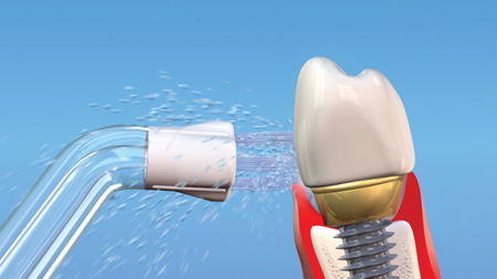 Waterpik® Water Flosser with the Plaque Seeker® tip cleaning around an implant. The water can access the interproximal and subgingival areas removing biofilm and debris.