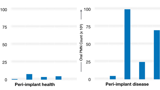 Maximizing the Lifespan of Dental Implants Placed in Young Individuals: The Role of Oral Neutrophils in Peri-Implant Diseases