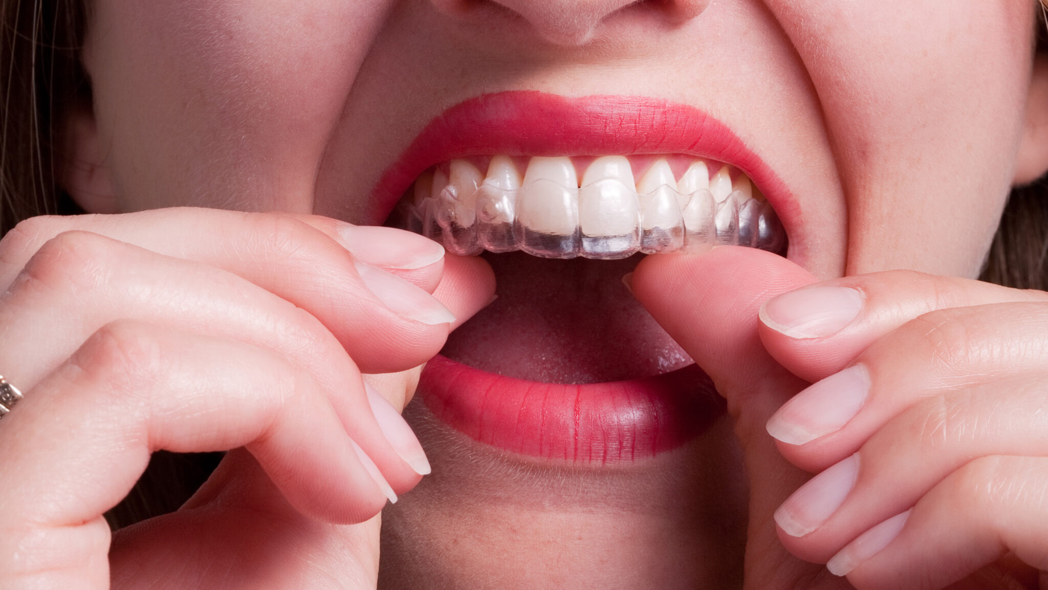 Heading Off the Orthodontics DIYers