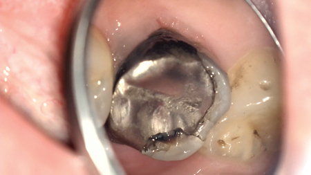 Consider very guarded endodontic and/or restorative prognosis for tooth #14