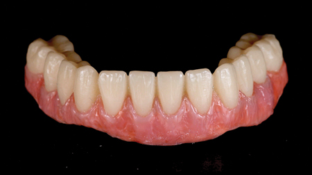 Frontal view of finished prosthesis.