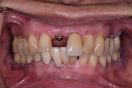 Intraoral photo showing frontal view of the patient in MIP with implant healing abutment.