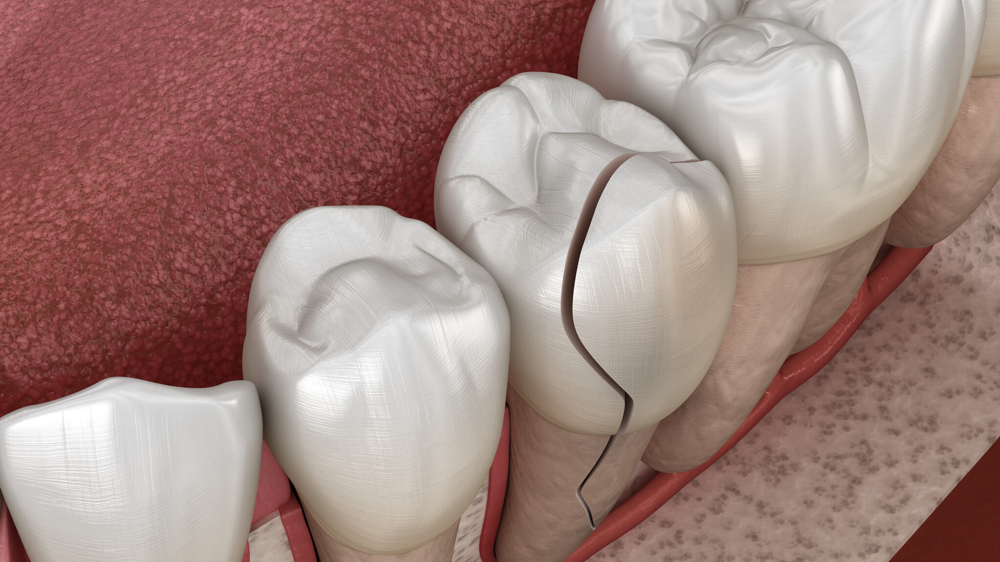 Cracked tooth, splitted. Medically accurate 3D illustration alternate text for this image