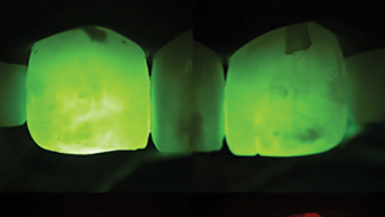 Tsujimoto infiltration Fig3 alternate text for this image