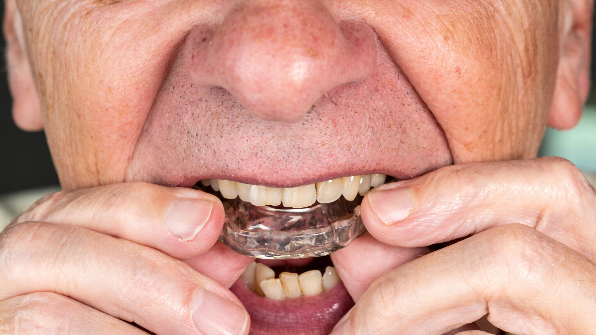 Senior man putting a night guard onto crooked teeth alternate text for this image