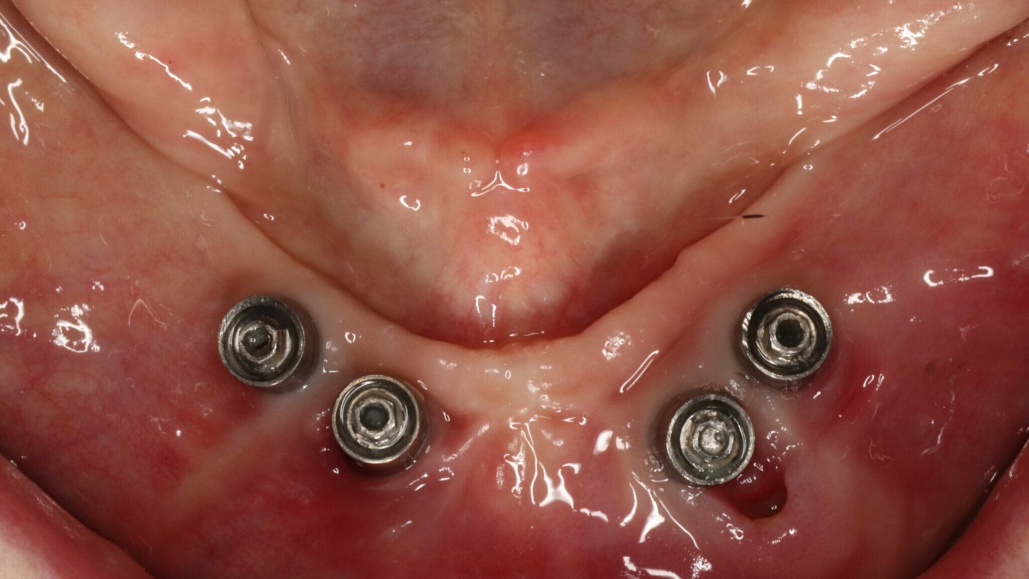 figure 3 – localized inflammation of site 32 alternate text for this image